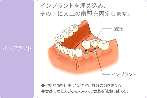インプラントを埋め込み、その上に人工の歯冠を固定します。