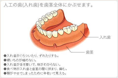 人工の歯(入れ歯)を歯茎全体にかぶせます。